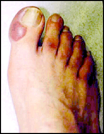 Figure 2-2. Superficial frostbite.