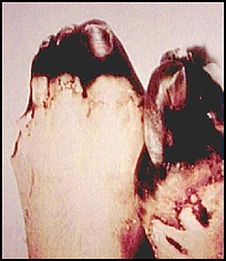 Figure 2-3. Deep frostbite.