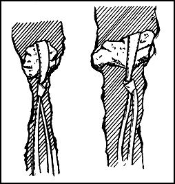 Figure 5-3. Chockstones.